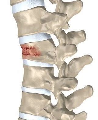 Патологические переломы позвонков