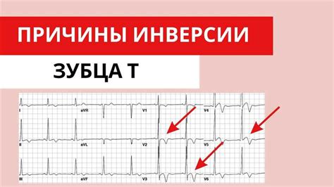 Патологические причины положительного зубца Т