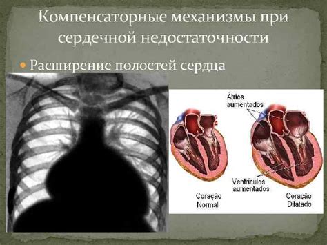 Патологическое расширение полостей сердца