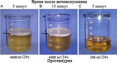 Пена в моче и белокурия: в чем разница?