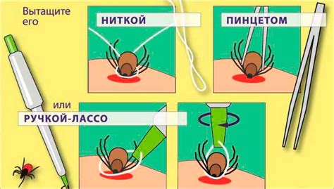 Первая помощь при оставшейся головке клеща