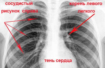 Первая причина деформации легочного рисунка на флюорографии