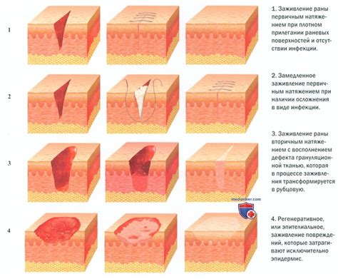 Первичное натяжение шва