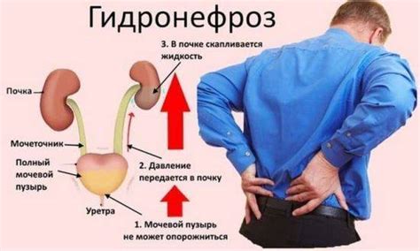 Первичное опущение почки у женщин: факторы риска и проявления