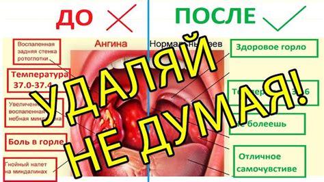 Первые последствия удаления гланд: что может произойти с организмом?