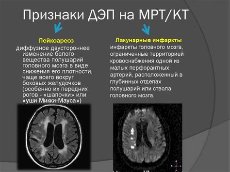 Первые проявления дисциркуляторной энцефалопатии