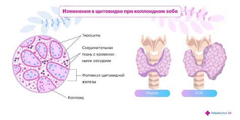 Первые симптомы коллоидного зоба