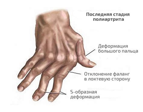 Первые симптомы отечности рук: их значения и значения