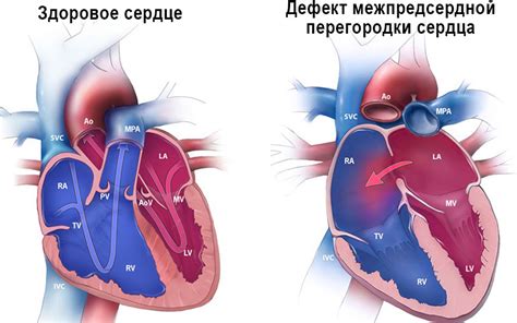 Перегородки сердца интактны: