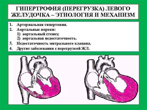 Перегрузка левого желудочка и сокращение его работоспособности