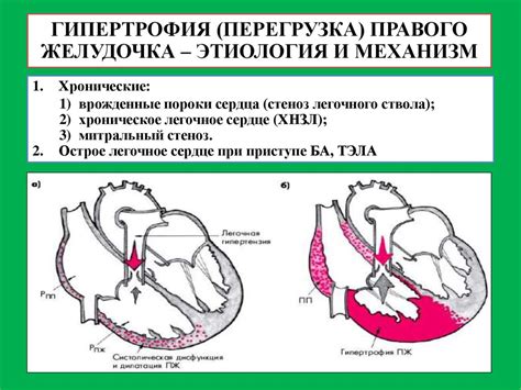 Перегрузка левого желудочка сердца