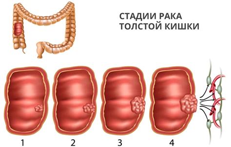 Перерастянутые петли кишечника