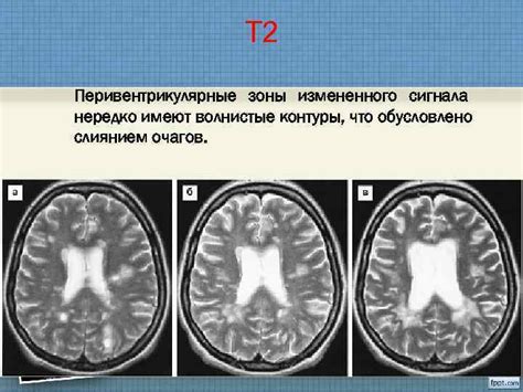 Перивентрикулярные зоны