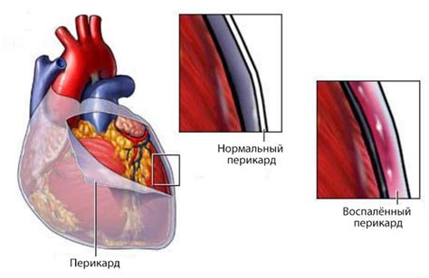 Перикардит: симптомы и последствия