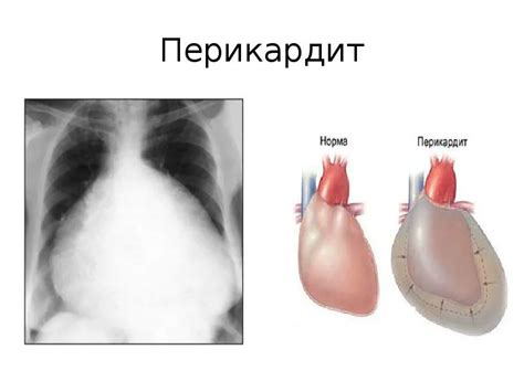 Перикардит: чем опасна эта болезнь?