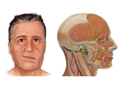 Периферический паралич лица
