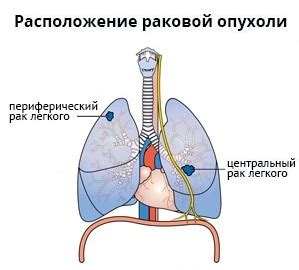 Периферическое образование нижней доли левого легкого