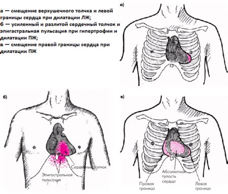 Перкуссия сердца: массаж, который улучшает кровообращение