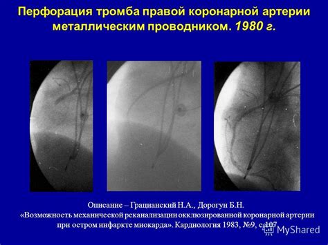 Перфорация в медицине