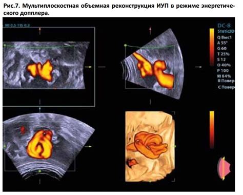 Петля пуповины на УЗИ: причины невидимости