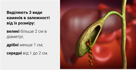 Питание и образ жизни при наличии небольшого камня в желчном пузыре