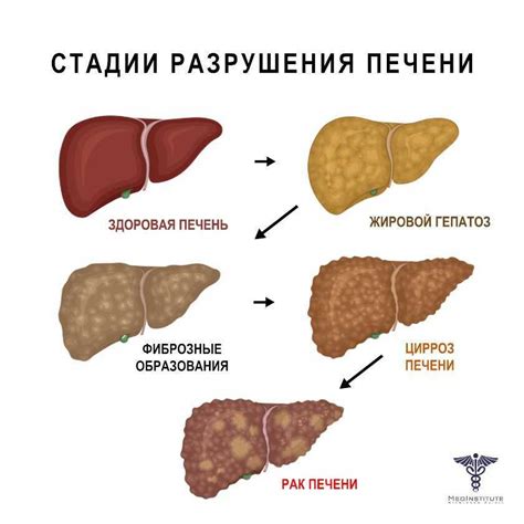 Питание и рацион для предотвращения и устранения гепатомегалии печени