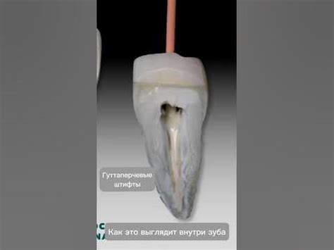 Пломбировка канала зуба: чего ожидать?