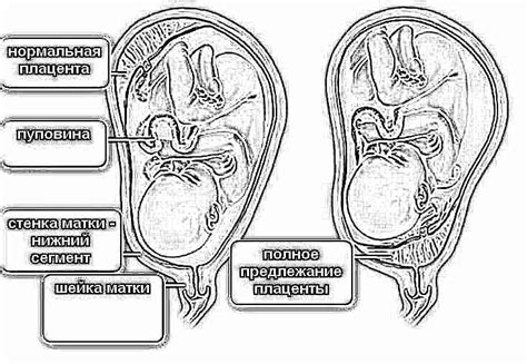 Плотно расположение плаценты