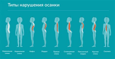 Плохая осанка и неправильное положение ног