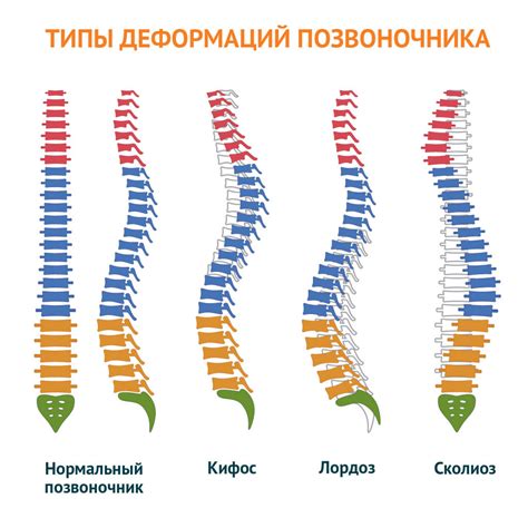 Плохая поза и деформация позвоночника