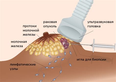 Плохой анализ биопсии: