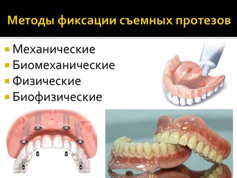 Плюсы и минусы съемных протезов при отсутствии нижних зубов