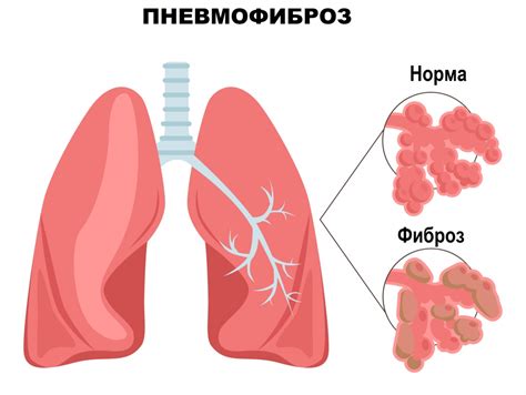 Пневмокониозы и хронические бронхопульмональные заболевания