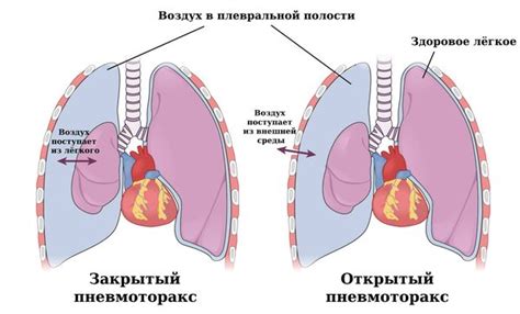 Пневмоторакс: понятие и причины возникновения