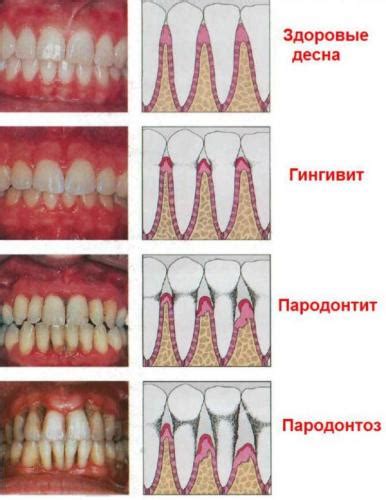 Побеление десен у взрослых