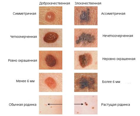 Повреждение кожи и образование родинок