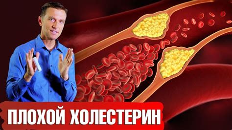 Повышенные уровни липопротеинов низкой плотности у взрослых мужчин: причины и последствия