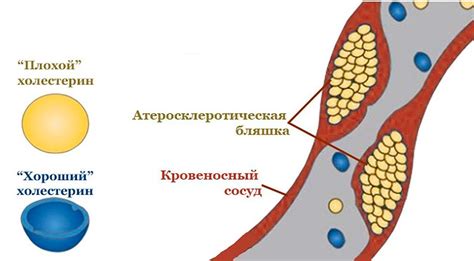 Повышенный холестерин высокой плотности: что это и как на него влияет