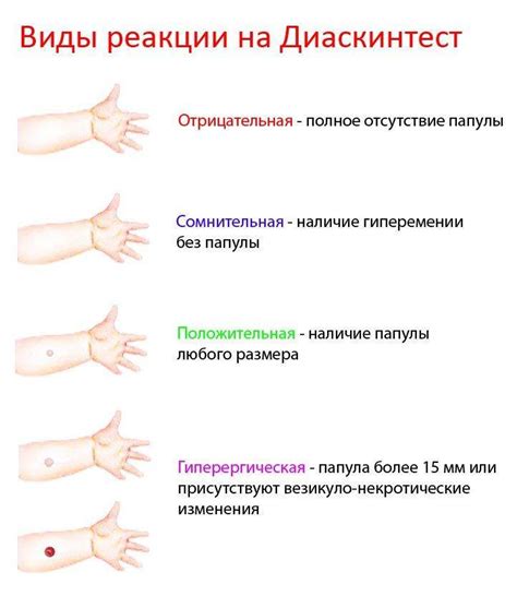 Подготовка и проведение Манту пробы