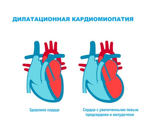 Подострый миокардит