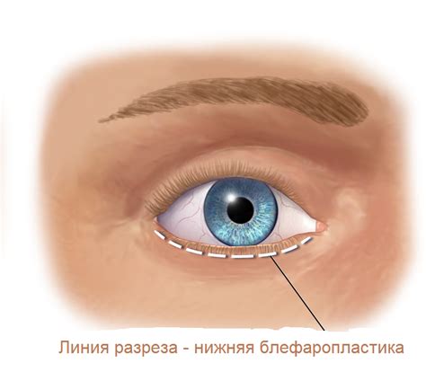 Подходы к нижней комбинированной блефаропластике