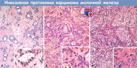 Позитивная инвазивная карцинома - определение и значение