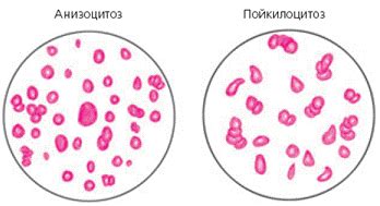 Пойкилоцитоз у женщин