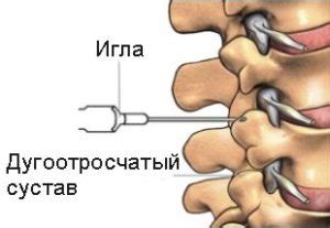 Показания для назначения блокады при остеохондрозе