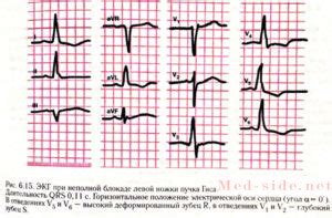 Показания для применения стимулятора сердца