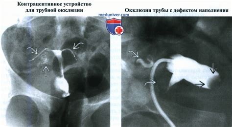 Показания для проведения гистеросальпингографии