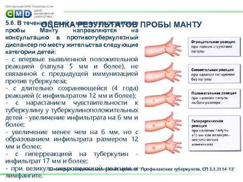 Показания для проведения процедуры манту