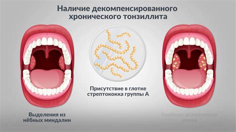 Показания для проведения тонзиллэктомии