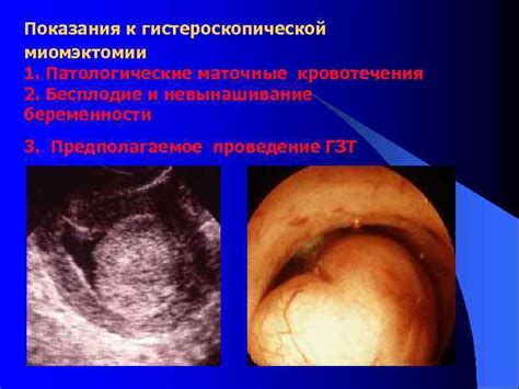 Показания к проведению гистерорезектоскопической миомэктомии