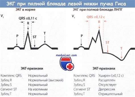 Полная блокада ЛНПГ